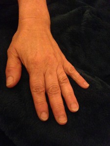 nail biting picking naperville hypnosis hypnotherapy